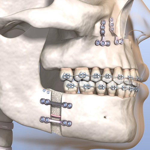 Maxillofacial Surgery