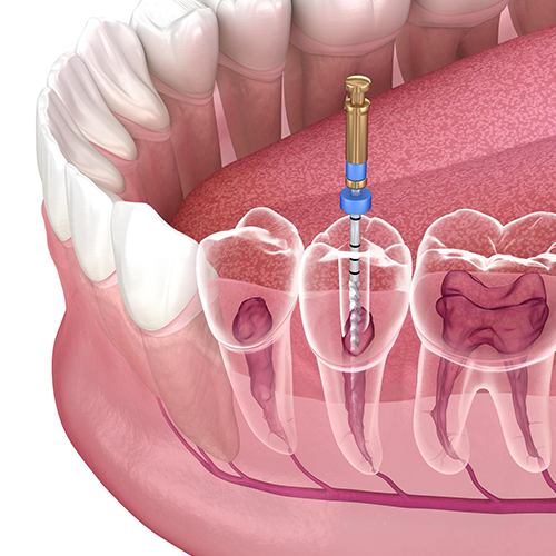 Endodontics