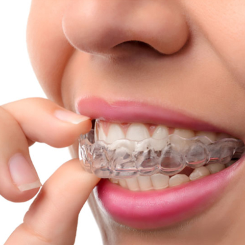 Orthondotics/Invisalign