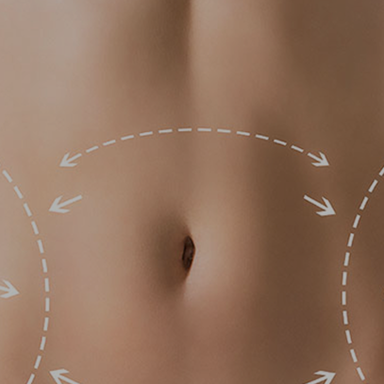 Addominoplastica-main